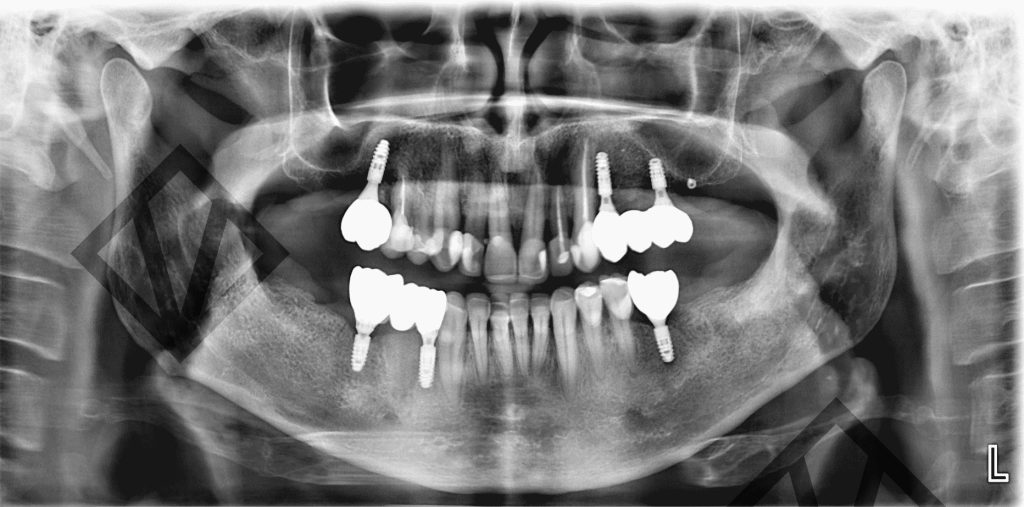 Panorámica de una mandíbula tratada con implantes