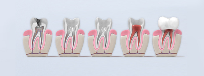 Proceso por el que pasa el diente durante una endodoncia